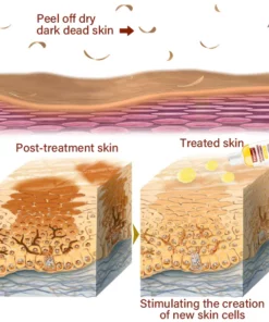 FurzeroTM Acanthosis Nigricans Peeling Oil