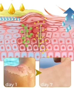 FurzeroTM Acanthosis Nigricans Peeling Oil
