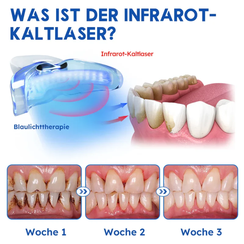Furzero™ Laser-Behandlungsgerät für Zahnfleischerkrankungen