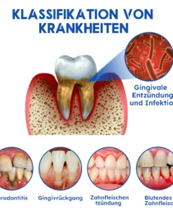 Furzero™ Laser-Behandlungsgerät für Zahnfleischerkrankungen