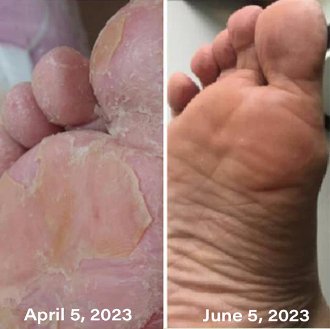 Furzero™ Medical Grade Nail Fungus Foot Strengthening Spray