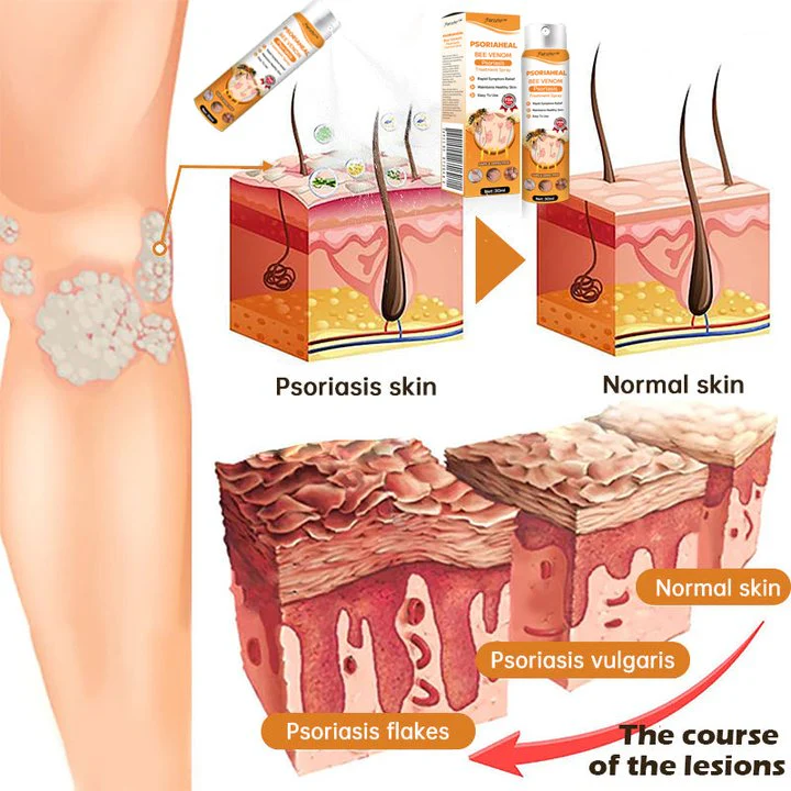 Furzero™ PsoriaHeal Bee Venom Psoriasis Treatment Spray