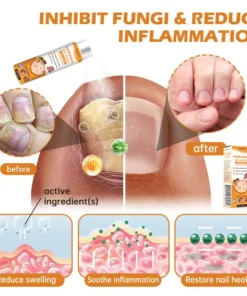 Furzero™ PsoriaHeal Bee Venom Psoriasis Treatment Spray