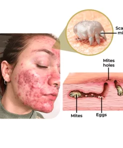 GFOUK™ AcneVe Anti-Mite Gold Foil Soap