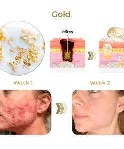 GFOUK™ AcneVe Anti-Mite Gold Foil Soap