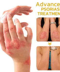 GFOUK™️ BeeVenom Psoriasis Treatment Cream