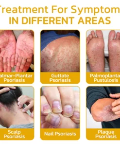 GFOUK™️ BeeVenom Psoriasis Treatment Cream