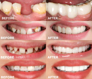 GleamSmile™ Snap-On Dentures- Affordable Smile Design- No Dentist - Image 6