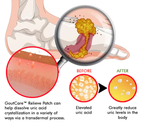 GoutCare™ Relieve Patch