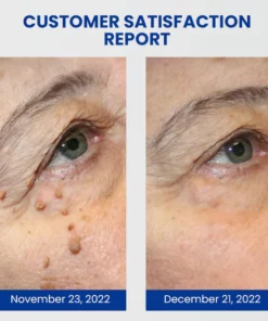 Neigeuses™ WartsOff Instant Blemish Removal Cream