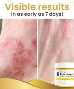 NutRelief™ Bee Venom Eczema Treatment Cream