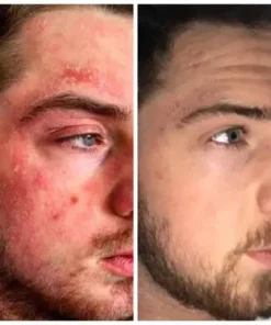 NutRelief™ Bee Venom Eczema Treatment Cream