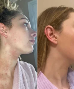 NutRelief™ Bee Venom Eczema Treatment Cream