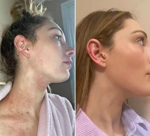 NutRelief™ Bee Venom Eczema Treatment Cream