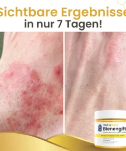 NutRelief™ Bienengift Ekzem Behandlung Creme