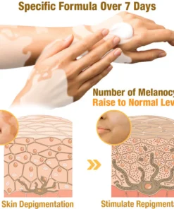 Oveallgo™ BeeVenom Vitiligo Treatment Cream