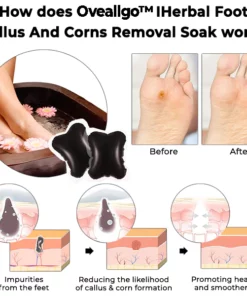 Alternative view of Oveallgo™ IHerbal Foot Callus And Corns Removal Soak