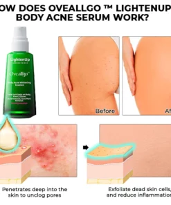 Alternative view of Oveallgo™ LightenUp Body Acne Serum
