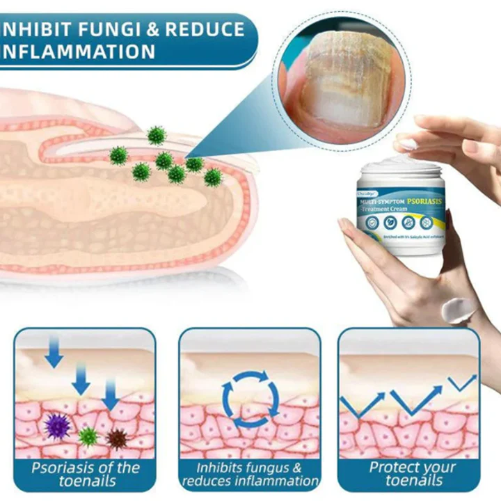 Oveallgo™ Multi-Symptom Psoriasis Treatment Cream