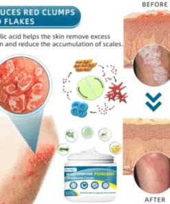 Oveallgo™ Multi-Symptom Psoriasis Treatment Cream