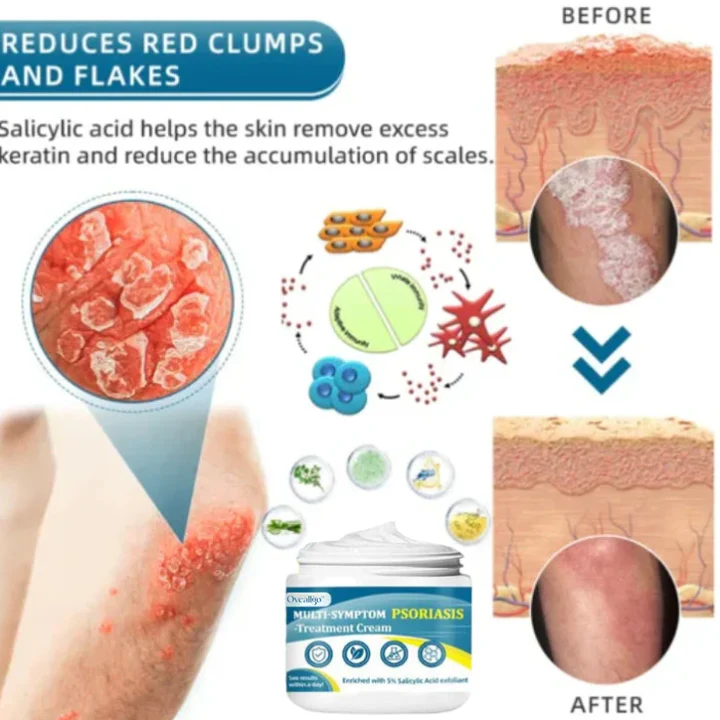 Oveallgo™ Multi-Symptom Psoriasis Treatment Cream