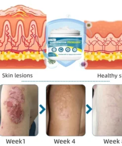Oveallgo™ Multi-Symptom Psoriasis Treatment Cream