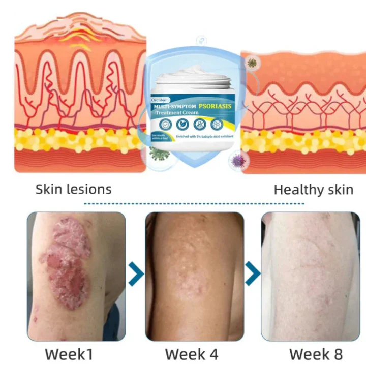Oveallgo™ Multi-Symptom Psoriasis Treatment Cream