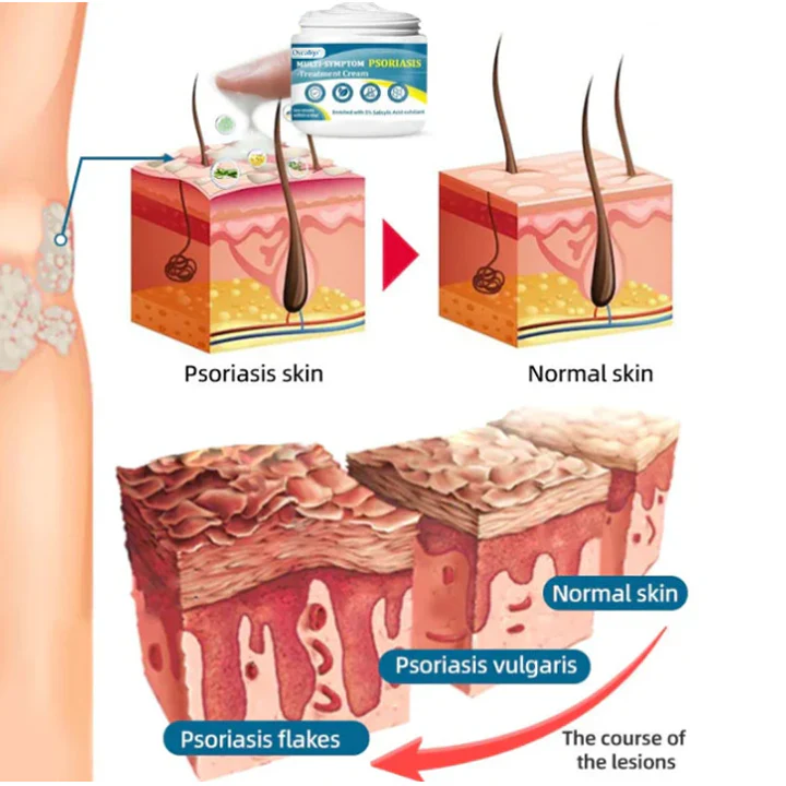 Oveallgo™ Multi-Symptom Psoriasis Treatment Cream