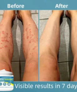 Oveallgo™ Multi-Symptom Psoriasis Treatment Cream