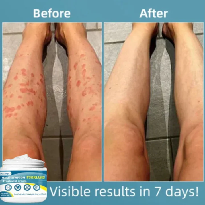 Oveallgo™ Multi-Symptom Psoriasis Treatment Cream