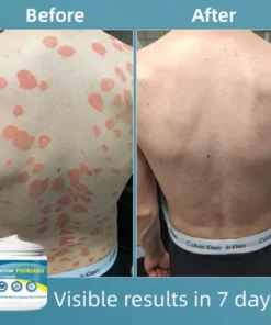 Oveallgo™ Multi-Symptom Psoriasis Treatment Cream