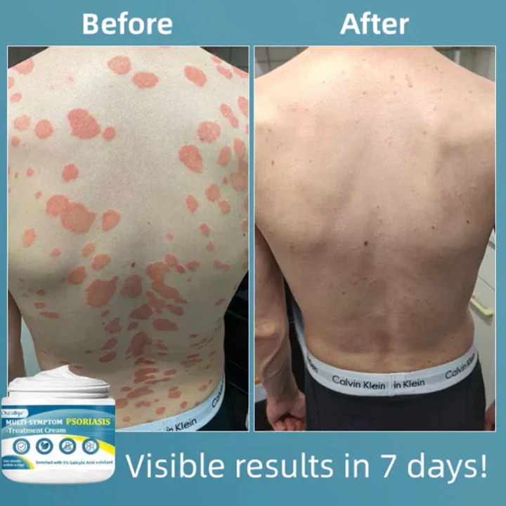 Oveallgo™ Multi-Symptom Psoriasis Treatment Cream