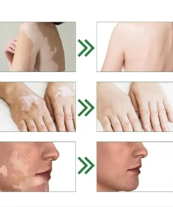 Oveallgo™ Squalene Vitiligo Treatment Cream