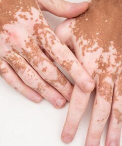 Oveallgo™ Squalene Vitiligo Treatment Cream