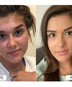 Oveallgo™ Squalene Vitiligo Treatment Cream