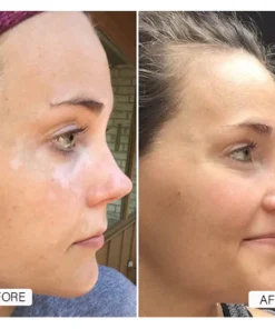 Oveallgo™ Squalene Vitiligo Treatment Cream