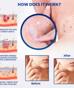 Oveallgo™ WartsOff NanoPURI Instant Blemish Removal Cream