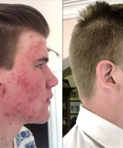 Oveallgo™ProX Cleansing Lotion for Acne & Spots & Acanthosis Nigricans