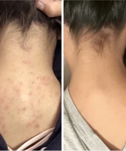 Oveallgo™ProX Cleansing Lotion for Acne & Spots & Acanthosis Nigricans