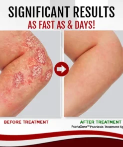 PsoriaGone™ Psoriasis Treatment Spray
