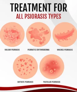 PsoriaGone™ Psoriasis Treatment Spray