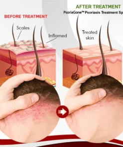 PsoriaGone™ Psoriasis Treatment Spray