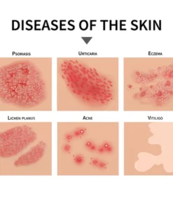 PsoriaGone™ Psoriasis relief spray