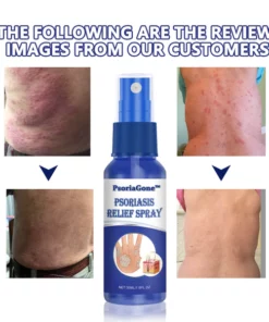 PsoriaGone™ Psoriasis relief spray