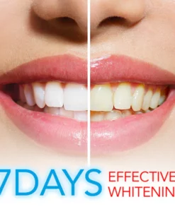 Alternative view of PureWhite Teeth™ Whitening Kit