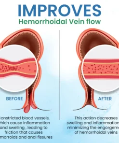 Quezy™ Hemorrhoids Treatment Gel