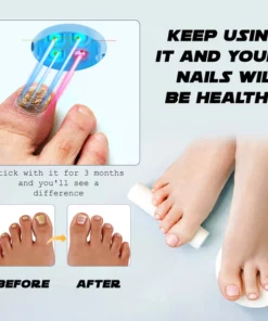 Alternative view of Ricpind NailFungal CleaningLaser TherapeuticDevice