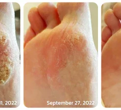 Seurico™ Professional Callus Remover Extra Strength Spray