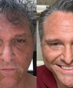 SkinDeux™ Bienengift Vitiligo Creme