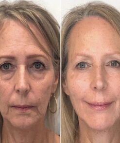 Furzero™ Botox Facial Essence